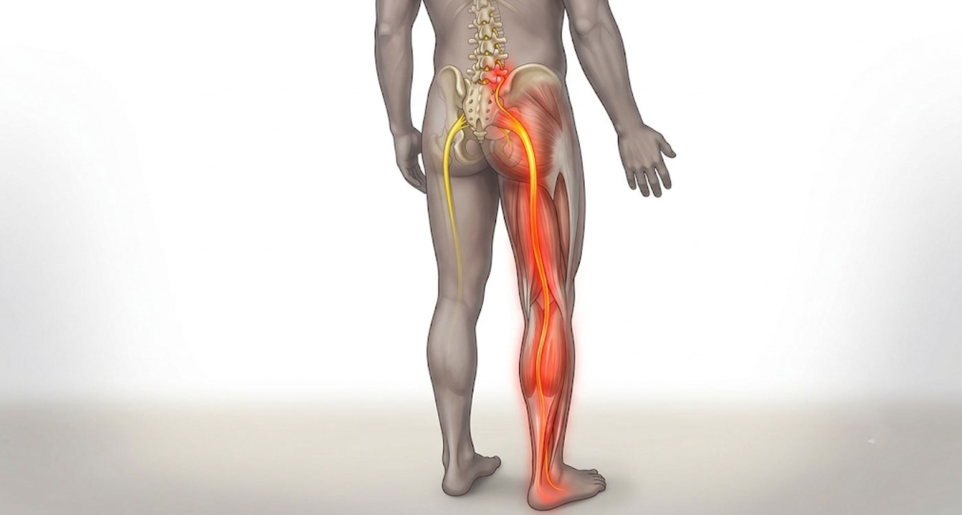 Sciatica